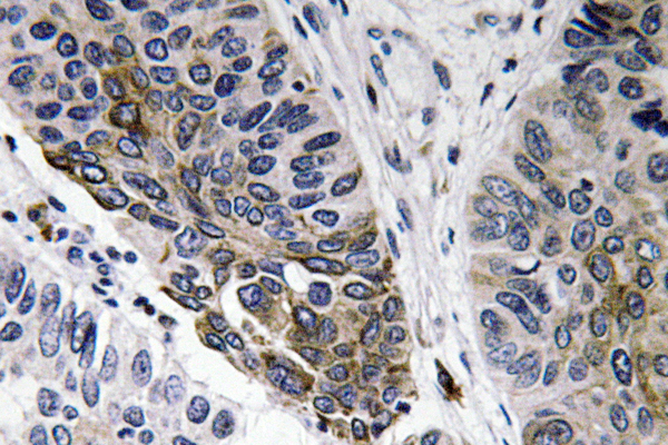 Human IgA Antibody - IHC of IgA (Y276) pAb in paraffin-embedded human lung carcinoma tissue.