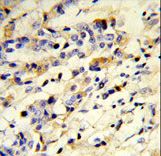 Human IgM Antibody - Formalin-fixed and paraffin-embedded human breast carcinoma reacted with IGHM Antibody , which was peroxidase-conjugated to the secondary antibody, followed by DAB staining. This data demonstrates the use of this antibody for immunohistochemistry; clinical relevance has not been evaluated.