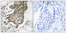 RABEP1 / Rabaptin-5 Antibody - Peptide - + Immunohistochemistry analysis of paraffin-embedded human breast carcinoma tissue using RABEP1 antibody.