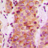 RABEP2 Antibody - Immunohistochemical analysis of Rabaptin 5 beta staining in human breast cancer formalin fixed paraffin embedded tissue section. The section was pre-treated using heat mediated antigen retrieval with sodium citrate buffer (pH 6.0). The section was then incubated with the antibody at room temperature and detected using an HRP conjugated compact polymer system. DAB was used as the chromogen. The section was then counterstained with hematoxylin and mounted with DPX.