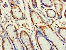 RABGAP1L Antibody - Immunohistochemistry of paraffin-embedded human gastric cancer at dilution 1:100