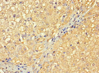 RABGAP1L Antibody - Paraffin-embedding Immunohistochemistry using human liver cancer at dilution 1:100