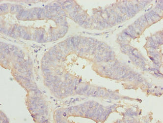 RABGEF1 Antibody - Immunohistochemistry of paraffin-embedded human endometrial cancer using RABGEF1 Antibody at dilution of 1:100
