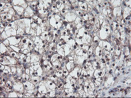 RABL2A Antibody - IHC of paraffin-embedded Carcinoma of Human kidney tissue using anti-RABL2A mouse monoclonal antibody.