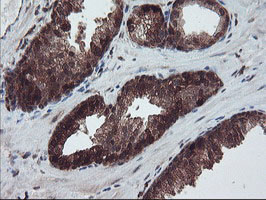 RABL2A Antibody - IHC of paraffin-embedded Carcinoma of Human prostate tissue using anti-RABL2A mouse monoclonal antibody.