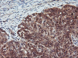 RABL2A Antibody - IHC of paraffin-embedded Adenocarcinoma of Human ovary tissue using anti-RABL2A mouse monoclonal antibody.