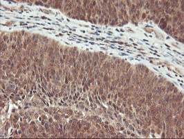 RABL2A Antibody - IHC of paraffin-embedded Carcinoma of Human bladder tissue using anti-RABL2A mouse monoclonal antibody.
