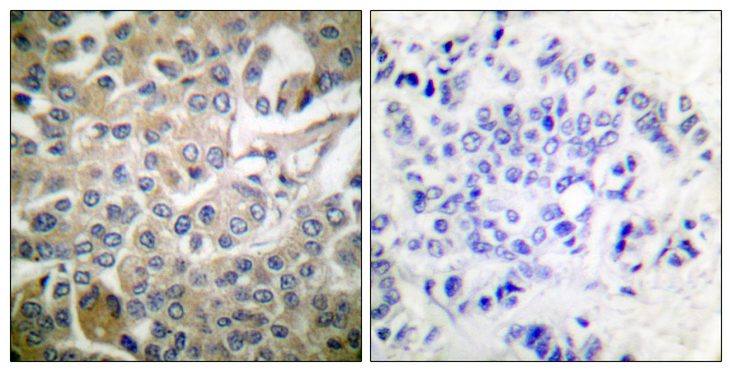 RAC1 Antibody - Immunohistochemistry analysis of paraffin-embedded human breast carcinoma tissue, using Rac1/CDC42 Antibody. The picture on the right is blocked with the synthesized peptide.