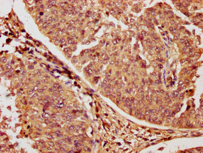 RAC1 Antibody - IHC image of RAC1 Antibody diluted at 1:1200 and staining in paraffin-embedded human cervical cancer performed on a Leica BondTM system. After dewaxing and hydration, antigen retrieval was mediated by high pressure in a citrate buffer (pH 6.0). Section was blocked with 10% normal goat serum 30min at RT. Then primary antibody (1% BSA) was incubated at 4°C overnight. The primary is detected by a biotinylated secondary antibody and visualized using an HRP conjugated SP system.