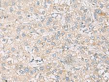 RAC2 Antibody - Immunohistochemistry of paraffin-embedded Human liver cancer tissue  using RAC2 Polyclonal Antibody at dilution of 1:60(×200)