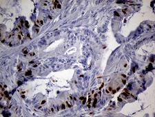 RACGAP1 / MGCRACGAP Antibody - Immunohistochemical staining of paraffin-embedded Carcinoma of Human spleen tissue within the normal limits using anti-RACGAP1 mouse monoclonal antibody. (Heat-induced epitope retrieval by 1mM EDTA in 10mM Tris buffer. (pH8.5) at 120°C for 3 min. (1:2000)