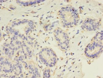 RAD17 Antibody - Immunohistochemistry of paraffin-embedded human breast cancer using antibody at 1:100 dilution.  This image was taken for the unconjugated form of this product. Other forms have not been tested.
