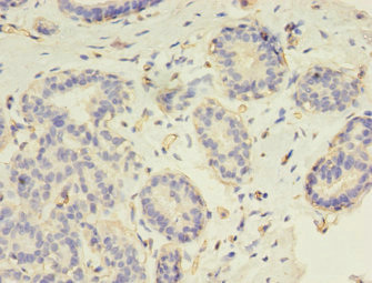 RAD17 Antibody - Immunohistochemistry of paraffin-embedded human breast cancer using RAD17 Antibody at dilution of 1:100