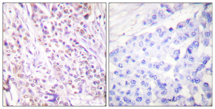 RAD17 Antibody - Immunohistochemistry analysis of paraffin-embedded human breast carcinoma tissue, using RAD17 Antibody. The picture on the right is blocked with the synthesized peptide.
