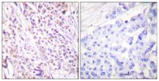 RAD17 Antibody - Immunohistochemistry analysis of paraffin-embedded human breast carcinoma tissue, using RAD17 Antibody. The picture on the right is blocked with the synthesized peptide.
