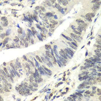 RAD17 Antibody - Immunohistochemistry of paraffin-embedded human colon carcinoma tissue.