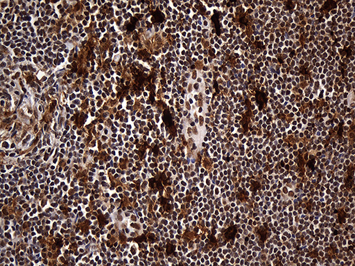 RAD21 Antibody - Immunohistochemical staining of paraffin-embedded Carcinoma of Human thyroid tissue using anti-RAD21 mouse monoclonal antibody. (Heat-induced epitope retrieval by 1mM EDTA in 10mM Tris buffer. (pH8.5) at 120°C for 3 min. (1:2000)
