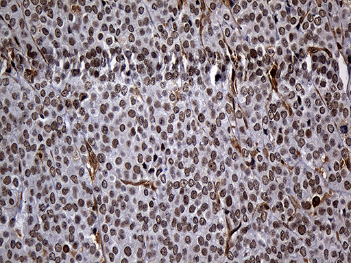 RAD21 Antibody - Immunohistochemical staining of paraffin-embedded Adenocarcinoma of Human breast tissue tissue using anti-RAD21 mouse monoclonal antibody. (Heat-induced epitope retrieval by 1mM EDTA in 10mM Tris buffer. (pH8.5) at 120°C for 3 min. (1:2000)