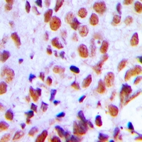 RAD21 Antibody - Immunohistochemical analysis of RAD21 staining in human breast cancer formalin fixed paraffin embedded tissue section. The section was pre-treated using heat mediated antigen retrieval with sodium citrate buffer (pH 6.0). The section was then incubated with the antibody at room temperature and detected with HRP and DAB as chromogen. The section was then counterstained with hematoxylin and mounted with DPX.
