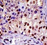 RAD23A / HHR23A Antibody - Formalin-fixed and paraffin-embedded human cancer tissue reacted with the primary antibody, which was peroxidase-conjugated to the secondary antibody, followed by DAB staining. This data demonstrates the use of this antibody for immunohistochemistry; clinical relevance has not been evaluated. BC = breast carcinoma; HC = hepatocarcinoma.