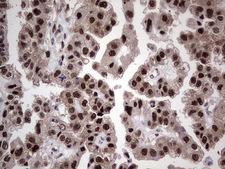 RAD23B / HR23B Antibody - Immunohistochemical staining of paraffin-embedded Adenocarcinoma of Human ovary tissue using anti-RAD23B mouse monoclonal antibody. (Heat-induced epitope retrieval by 1 mM EDTA in 10mM Tris, pH8.5, 120C for 3min,