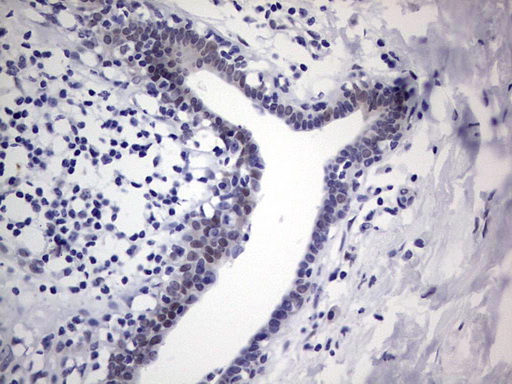 RAD23B / HR23B Antibody - Immunohistochemical staining of paraffin-embedded Adenocarcinoma of Human breast tissue using anti-RAD23B mouse monoclonal antibody. (Heat-induced epitope retrieval by 1 mM EDTA in 10mM Tris, pH8.5, 120C for 3min,