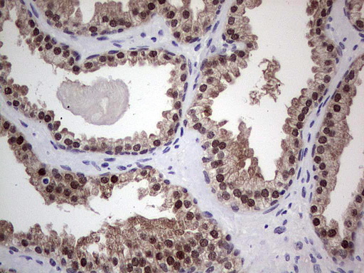 RAD23B / HR23B Antibody - Immunohistochemical staining of paraffin-embedded Carcinoma of Human prostate tissue using anti-RAD23B mouse monoclonal antibody. (Heat-induced epitope retrieval by 1 mM EDTA in 10mM Tris, pH8.5, 120C for 3min,
