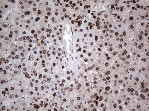 RAD23B / HR23B Antibody - Immunohistochemical staining of paraffin-embedded Carcinoma of Human liver tissue using anti-RAD23B mouse monoclonal antibody. (Heat-induced epitope retrieval by 1 mM EDTA in 10mM Tris, pH8.5, 120C for 3min,