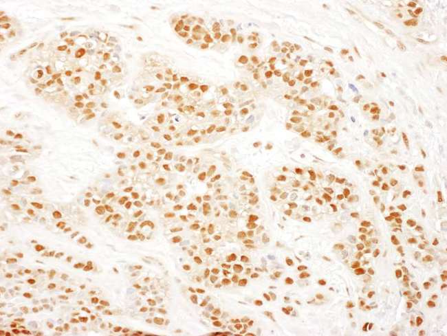 RAD23B / HR23B Antibody - Detection of Human RAD23B by Immunohistochemistry. Sample: FFPE section of human breast carcinoma. Antibody: Affinity purified rabbit anti-RAD23B used at a dilution of 1:1000 (0.2 ug/ml). Detection: DAB.