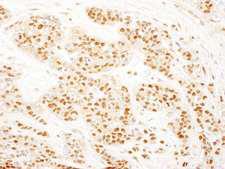 RAD23B / HR23B Antibody - Detection of Human RAD23B by Immunohistochemistry. Sample: FFPE section of human breast carcinoma. Antibody: Affinity purified rabbit anti-RAD23B used at a dilution of 1:1000 (0.2 ug/ml). Detection: DAB.