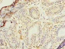 RAD23B / HR23B Antibody - Immunohistochemistry of paraffin-embedded human breast cancer using RAD23B Antibody at dilution of 1:100