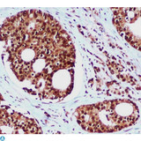 RAD23B / HR23B Antibody - Immunohistochemical analysis of paraffin-embedded Prostate Cancer using hHR23b mouse mAb (1:100 dilution).Antigen retrieval was performed by pressure cooking in citrate buffer (pH 6.0).
