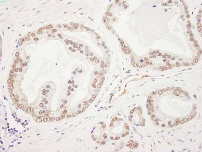 RAD50 Antibody - Detection of Human Rad50 by Immunohistochemistry. Sample: FFPE section of human prostate carcinoma. Antibody: Affinity purified rabbit anti-Rad50 used at a dilution of 1:1000 (1 ug/ml). Detection: DAB.