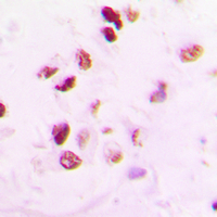 RAD50 Antibody - Immunohistochemical analysis of RAD50 staining in human lung cancer formalin fixed paraffin embedded tissue section. The section was pre-treated using heat mediated antigen retrieval with sodium citrate buffer (pH 6.0). The section was then incubated with the antibody at room temperature and detected using an HRP conjugated compact polymer system. DAB was used as the chromogen. The section was then counterstained with hematoxylin and mounted with DPX.