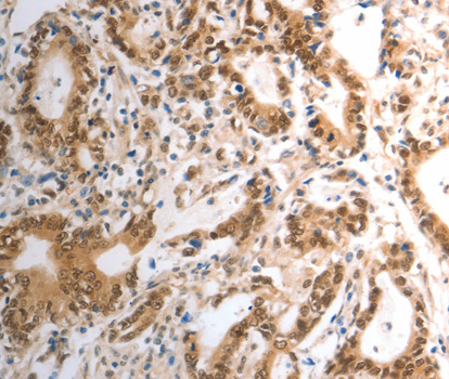RAD50 Antibody - Immunohistochemistry of paraffin-embedded human gastric cancer tissue.