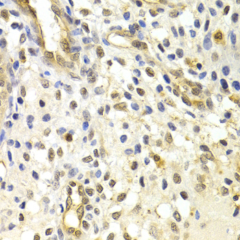 RAD50 Antibody - Immunohistochemistry of paraffin-embedded human metrocarcinoma tissue.