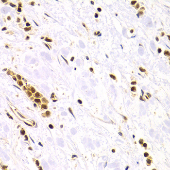 RAD50 Antibody - Immunohistochemistry of paraffin-embedded human stomach cancer tissue.