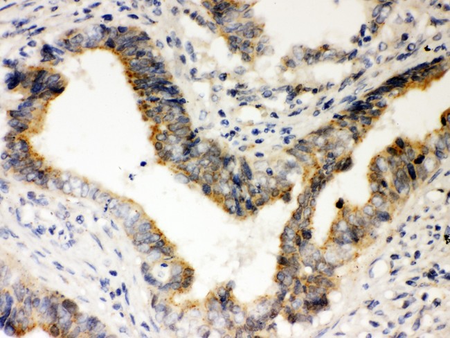 RAD51 / RECA Antibody - Rad51 antibody IHC-paraffin: Human Intestinal Cancer Tissue.