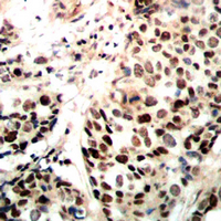 RAD51 / RECA Antibody - Immunohistochemical analysis of RAD51A staining in human breast cancer formalin fixed paraffin embedded tissue section. The section was pre-treated using heat mediated antigen retrieval with sodium citrate buffer (pH 6.0). The section was then incubated with the antibody at room temperature and detected using an HRP conjugated compact polymer system. DAB was used as the chromogen. The section was then counterstained with hematoxylin and mounted with DPX.