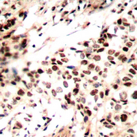 RAD51 / RECA Antibody - Immunohistochemical analysis of RAD51A (pY315) staining in human breast cancer formalin fixed paraffin embedded tissue section. The section was pre-treated using heat mediated antigen retrieval with sodium citrate buffer (pH 6.0). The section was then incubated with the antibody at room temperature and detected using an HRP conjugated compact polymer system. DAB was used as the chromogen. The section was then counterstained with hematoxylin and mounted with DPX.