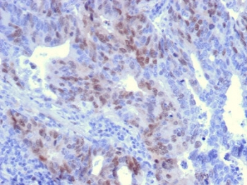 RAD51 / RECA Antibody - IHC staining of FFPE human colon carcinoma with RAD51 antibody. HIER: boil tissue sections in pH6, 10mM citrate buffer, for 10-20 min and allow to cool before testing.