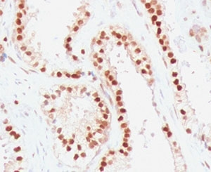 RAD51 / RECA Antibody - IHC staining of FFPE human colon carcinoma with RAD51 antibody (clone RALPA-1). HIER: boil tissue sections in pH6, 10mM citrate buffer, for 10-20 min and allow to cool before testing.