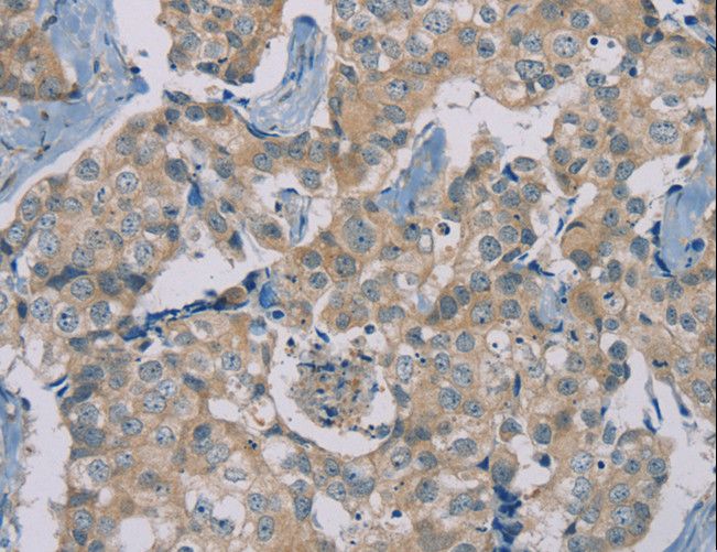 RAD51 / RECA Antibody - Immunohistochemistry of paraffin-embedded Human breast cancer using RAD51 Polyclonal Antibody at dilution of 1:40.