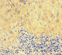 RAD51 / RECA Antibody - Immunohistochemistry of paraffin-embedded human liver cancer at dilution of 1:100