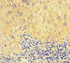 RAD51 / RECA Antibody - Immunohistochemistry of paraffin-embedded human liver cancer at dilution of 1:100