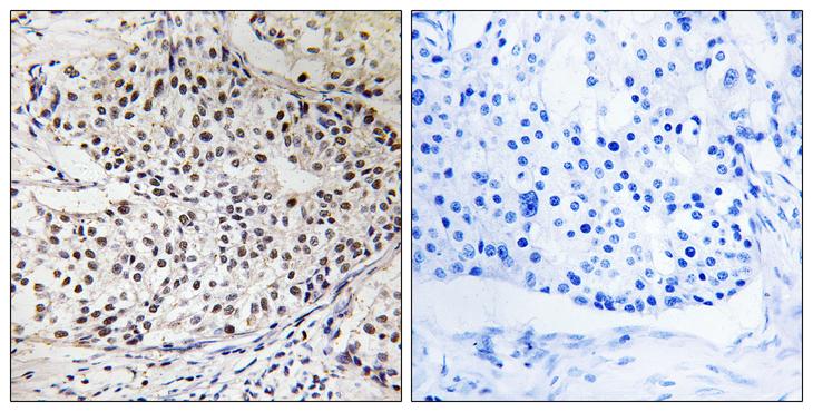 RAD51 / RECA Antibody - P-peptide - + Immunohistochemistry analysis of paraffin-embedded human breast carcinoma tissue, using RAD51 (Phospho-Thr309) antibody.