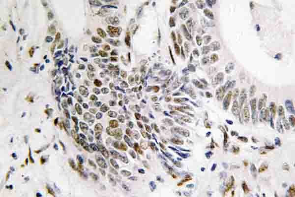 RAD51 / RECA Antibody - IHC of Rad51 (T309) pAb in paraffin-embedded human colon carcinoma tissue.