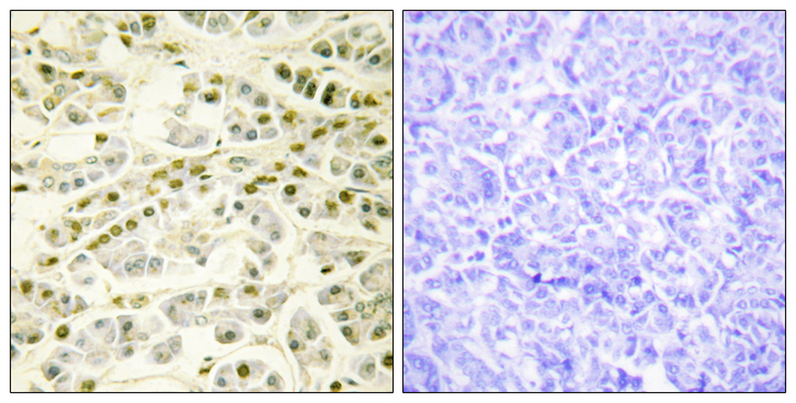 RAD51B Antibody - Immunohistochemistry analysis of paraffin-embedded human pancreas tissue, using RAD51L1 Antibody. The picture on the right is blocked with the synthesized peptide.