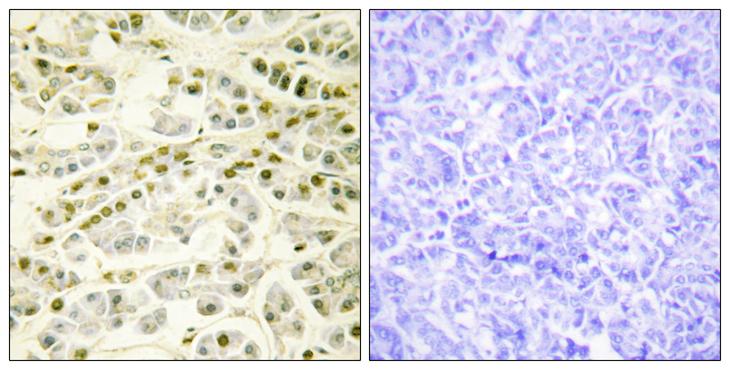 RAD51B Antibody - Peptide - + Immunohistochemistry analysis of paraffin-embedded human pancreas tissue using RAD51L1 antibody.