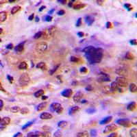 RAD51C Antibody - Immunohistochemical analysis of RAD51C staining in human breast cancer formalin fixed paraffin embedded tissue section. The section was pre-treated using heat mediated antigen retrieval with sodium citrate buffer (pH 6.0). The section was then incubated with the antibody at room temperature and detected using an HRP-conjugated compact polymer system. DAB was used as the chromogen. The section was then counterstained with hematoxylin and mounted with DPX.